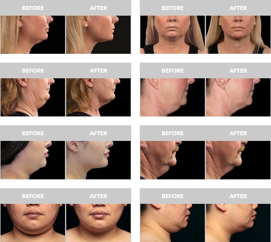 Coolsculpting Chin Results