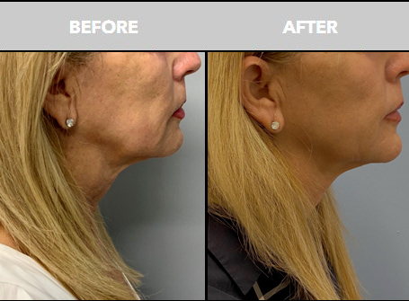 Before and After Sofwave at The Skin Center