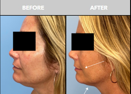 Before and After Sofwave at The Skin Center