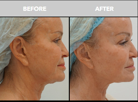 Sofwave at The Skin Center Before and After