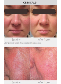 Before and After Mandelic Acid Peel